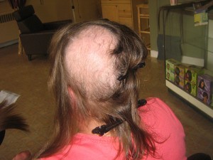maryclaris_alopecia_patient_before-300x225